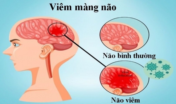 Viêm màng não gây ảnh hưởng nghiêm trọng đến chức năng não bộ