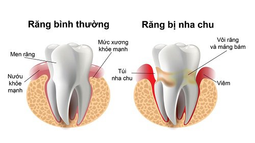 Hình ảnh minh họa sự khác biệt giữa viêm nướu và viêm nha chu