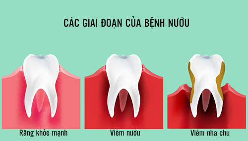 Biểu hiện thường gặp ở viêm nướu