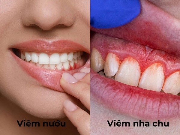 Tác hại nguy hiểm của viêm nha chu