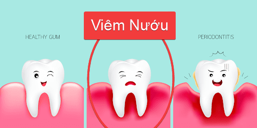 So sánh mức độ nguy hiểm giữa viêm nướu và viêm nha chu