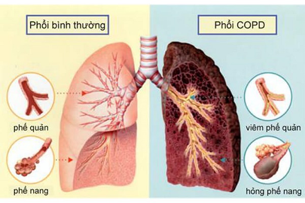 Viêm phế quản kéo dài dễ tiến triển thành COPD nếu không được xử lý