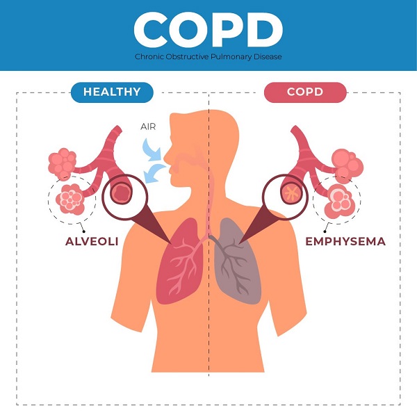 Các giai đoạn phát triển từ viêm phế quản sang COPD