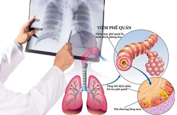 Nguy cơ gặp biến chứng nguy hiểm khi chủ quan với triệu chứng của phổi