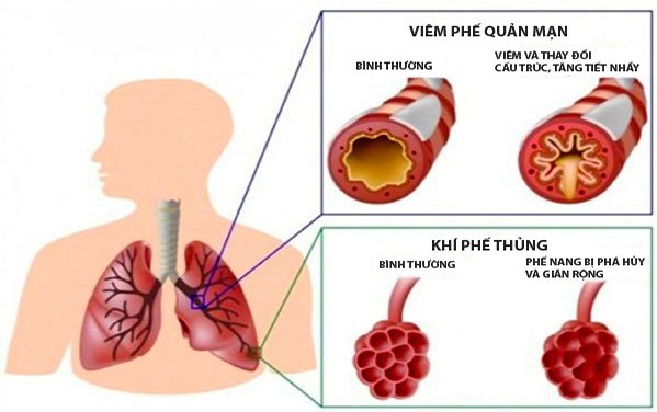 Dùng thảo dược uy tín hỗ trợ điều trị viêm phế quản và phòng ngừa COPD