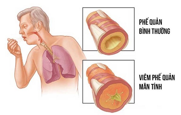 Triệu chứng viêm phế quản và mối liên hệ với viêm phổi