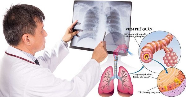 Biến chứng nguy hiểm của viêm phế quản: viêm phổi