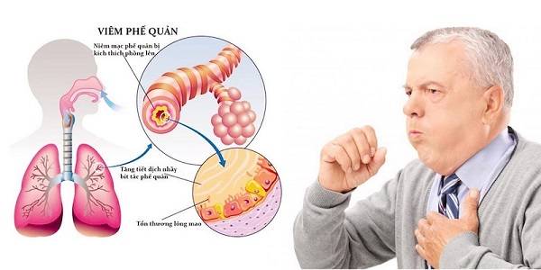 Phòng ngừa và điều trị viêm phế quản, viêm phổi hiệu quả