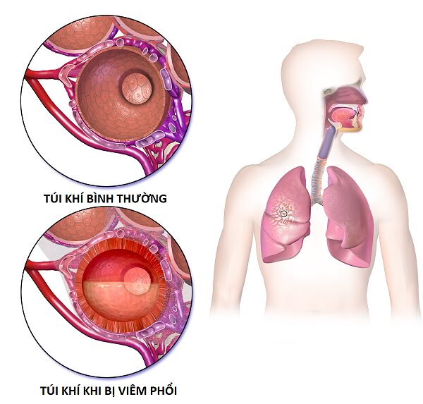 Viêm phổi là gì – Dấu hiệu không nên bỏ qua
