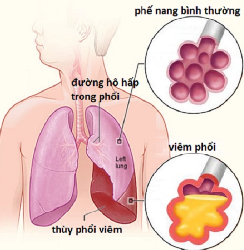 Tác động của viêm phổi đến sinh lý nam
