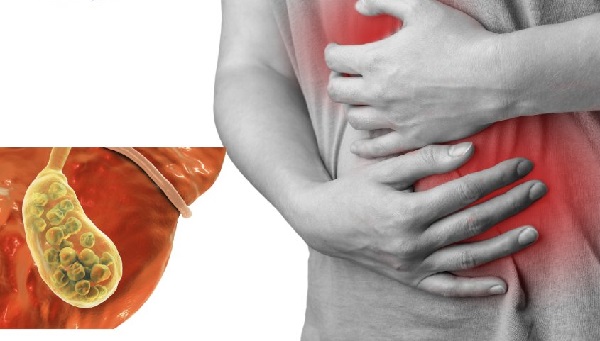 Cảnh báo: Sỏi mật kéo dài có thể gây biến chứng nguy hiểm