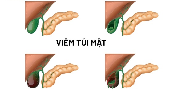 Vai trò hỗ trợ của thảo dược với sỏi mật, viêm túi mật
