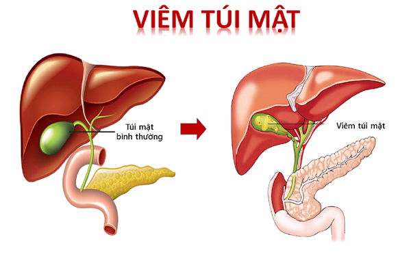Hình minh họa viêm túi mật có sỏi và các triệu chứng sốt cao, mệt mỏi