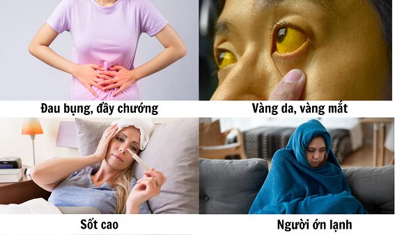 Các loại thảo dược thiên nhiên hỗ trợ điều trị sỏi mật, viêm túi mật