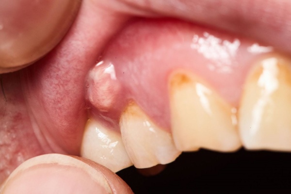 Hình ảnh minh họa viêm tủy răng có nên nhổ không