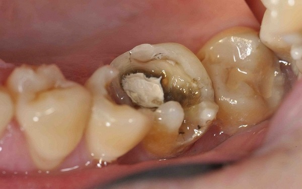 So sánh các cách xử lý viêm tủy răng