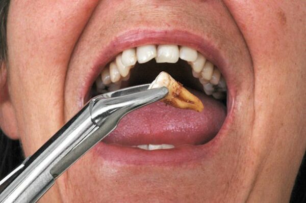Rủi ro khi nhổ răng viêm tủy