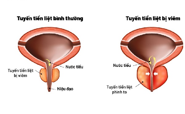 Nguyên nhân gây viêm tuyến tiền liệt