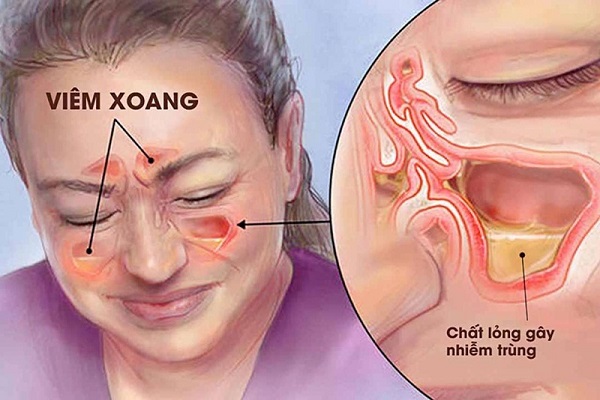 Mối liên hệ giữa viêm xoang và viêm họng trong sức khỏe tai mũi họng