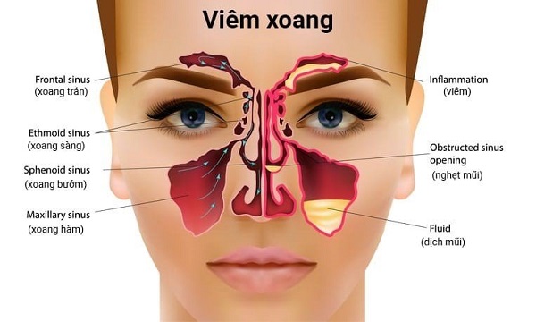 Minh họa tình trạng viêm xoang và các vấn đề tai mũi họng