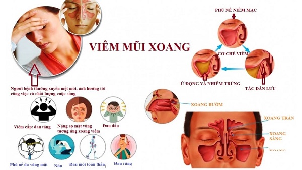 Triệu chứng và nguyên nhân viêm xoang trong hệ tai mũi họng