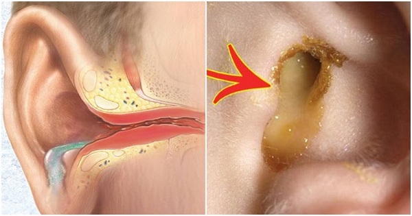 Hướng dẫn phòng ngừa viêm tai giữa