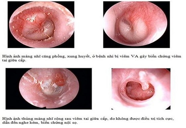Ảnh minh họa viêm tai giữa và tầm quan trọng chuẩn đoán đúng