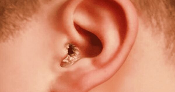 Triệu chứng nấm tai thường gặp trong tai mũi họng