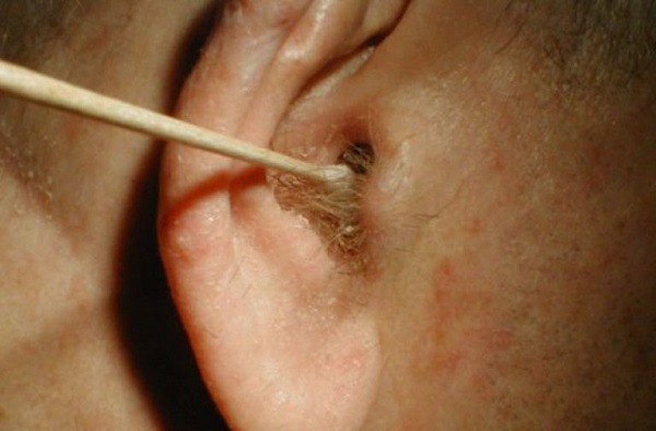 Nấm tai và tác động với các bệnh tai mũi họng