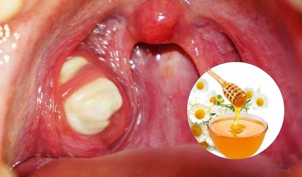 Nguy cơ khi sử dụng thuốc nam điều trị viêm amidan không đúng cách