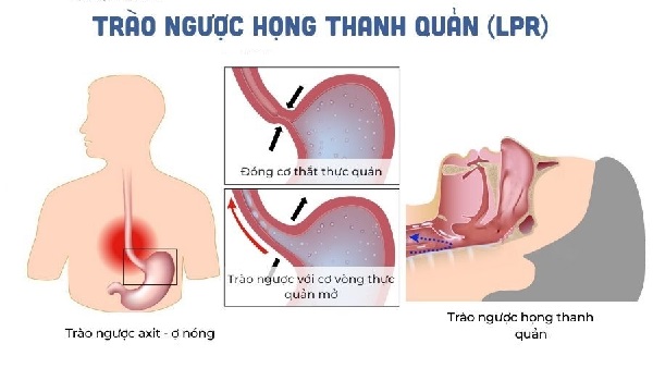 Acid trào ngược phá hủy thanh quản