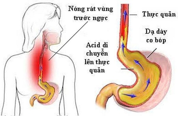 Triệu chứng viêm thanh quản do trào ngược