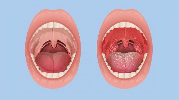 Hiệu quả trị liệu tự nhiên hỗ trợ viêm amidan