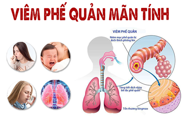 Ảnh minh họa viêm thanh quản và vị trí trong hệ tai mũi họng