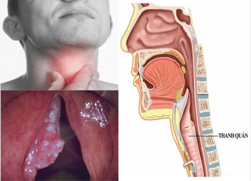 Dấu hiệu viêm thanh quản và nguy cơ ung thư vòm họng