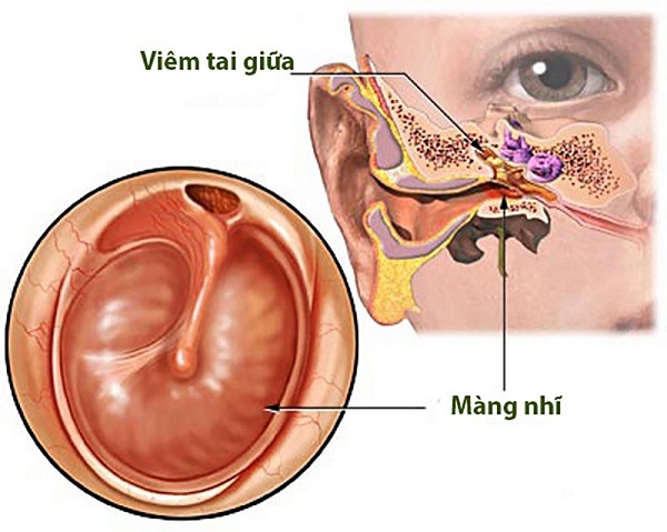 Triệu chứng viêm tai giữa