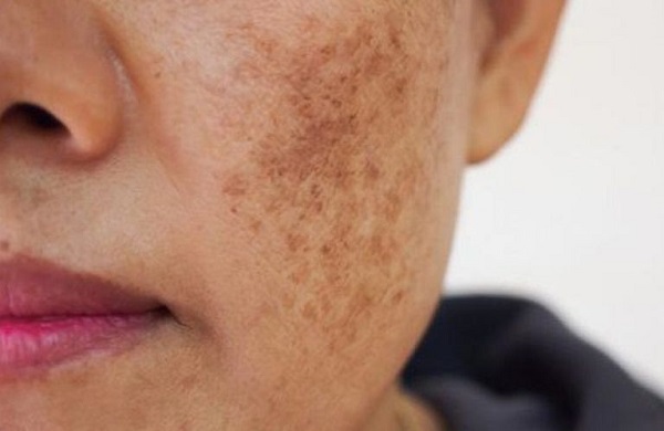 Vai trò của vitamin C với làn da