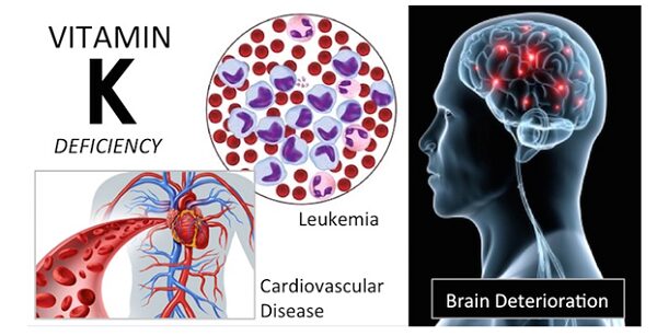 Ảnh hưởng nghiêm trọng của thiếu vitamin K