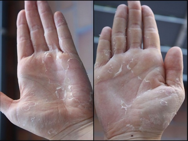 Lời khuyên phòng ngừa thiếu vitamin C