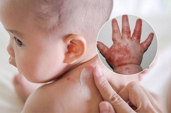 Dấu hiệu thiếu kẽm ở trẻ nhỏ