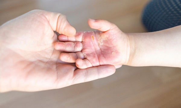 Các triệu chứng thiếu vitamin A liên quan đến tai mũi họng