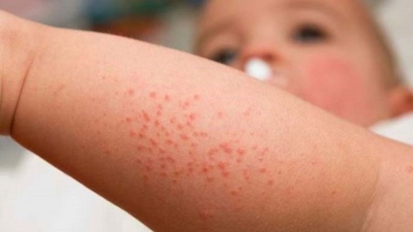 Bổ sung vitamin A cho trẻ – giải pháp phòng ngừa các bệnh tai mũi họng