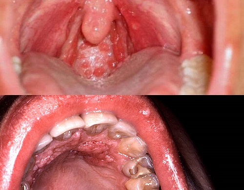 Hình minh họa về viêm họng hạt và viêm họng cấp