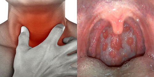 Nhận diện triệu chứng viêm họng hạt và viêm họng cấp