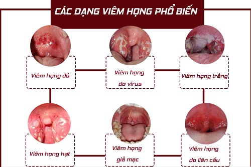 Cách phòng ngừa viêm họng hạt và viêm họng cấp hiệu quả